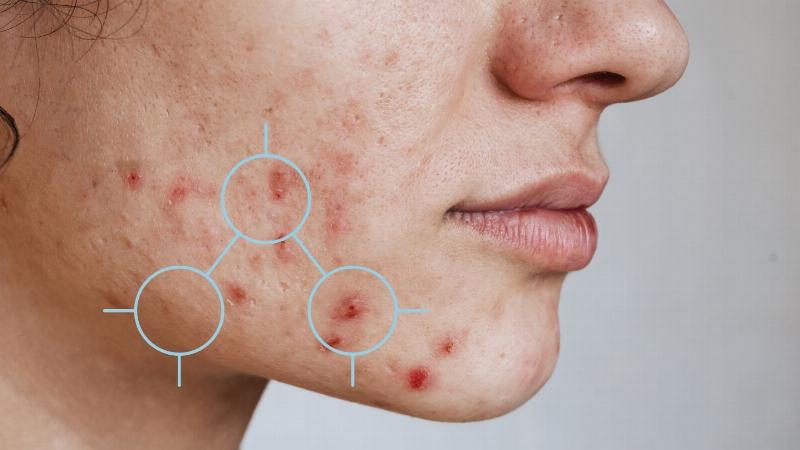 Thâm Mụn Nên Dùng Gì Để Da Sáng Mịn Tự Tin?
